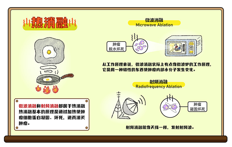 肺結(jié)節(jié)的消融治療