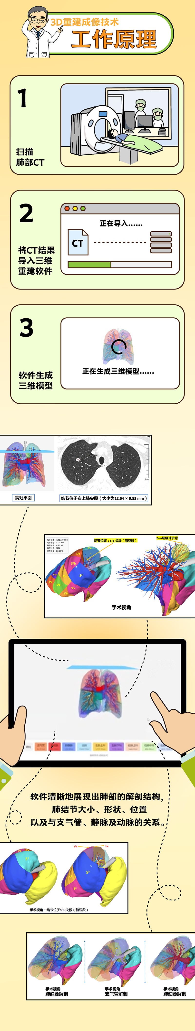 肺結(jié)節(jié)小劇場(chǎng) vol10 ｜3D重建成像技術(shù)——助力微創(chuàng)精準(zhǔn)切除